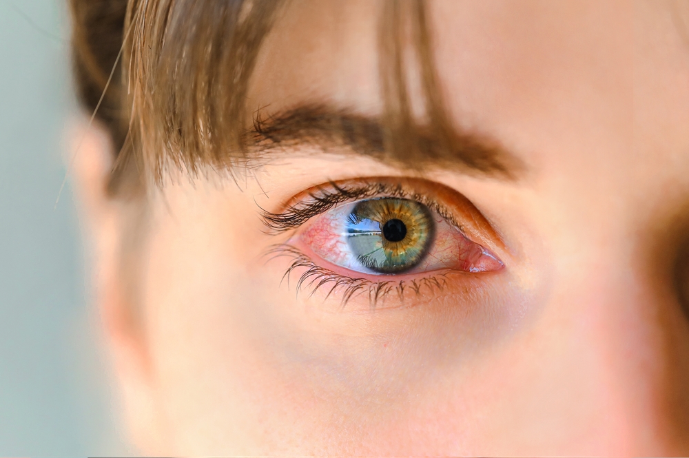 Eye Infection Treatment in Chapel Hill, NC Eye Infection Treatment in Chapel Hill, NC